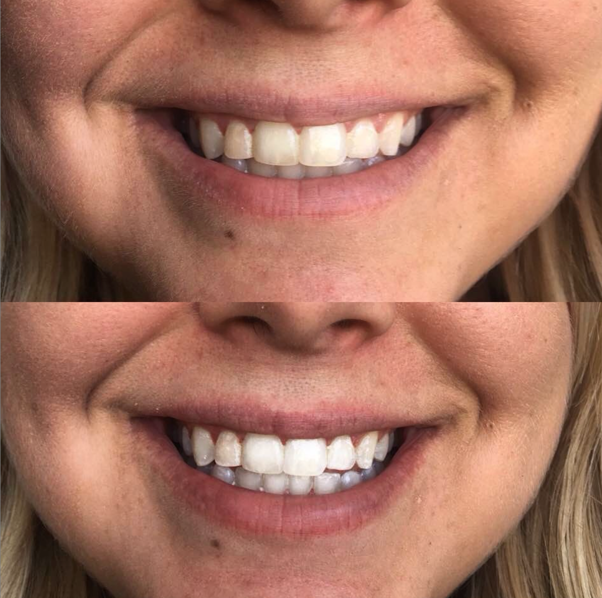 cozy smile kit BF DEAL